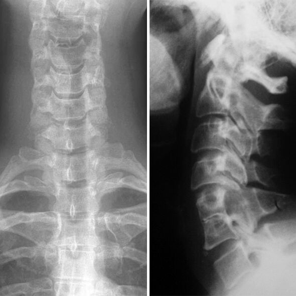 X -aj cervical spine