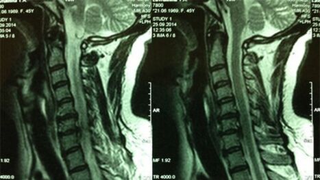 MRI cervical deplet