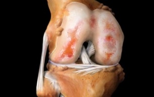 what is knee osteoarthritis