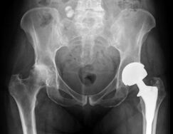diagnosis of hip arthrosis